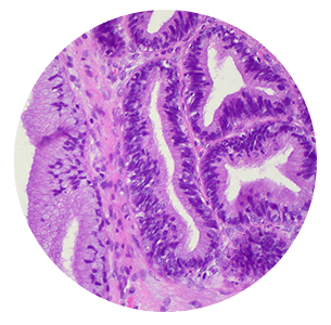 adenocarcinoma