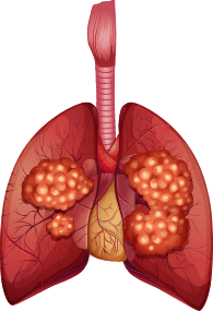 carcinoma