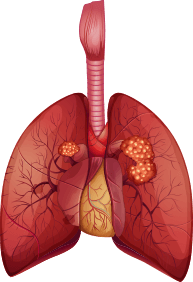 squamous